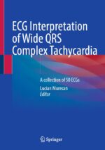ECG Interpretation of Wide QRS Complex Tachycardia: A collection of 50 ECGs (Original PDF from Publisher)